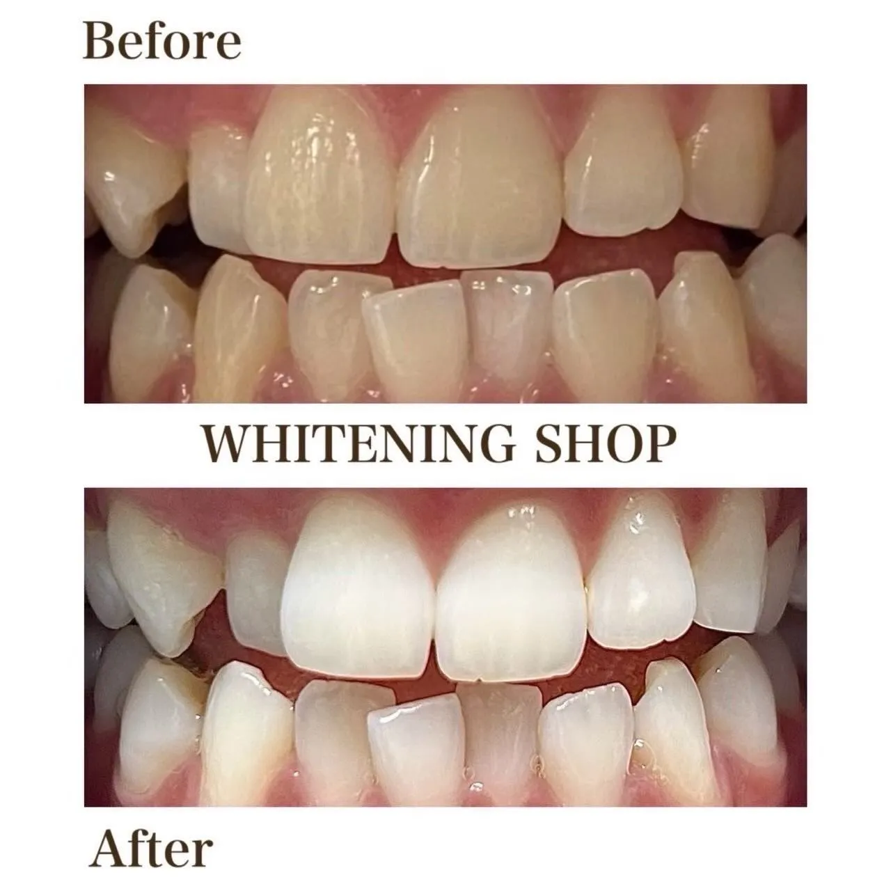 虫歯や知覚過敏があってもOK🙆♀️