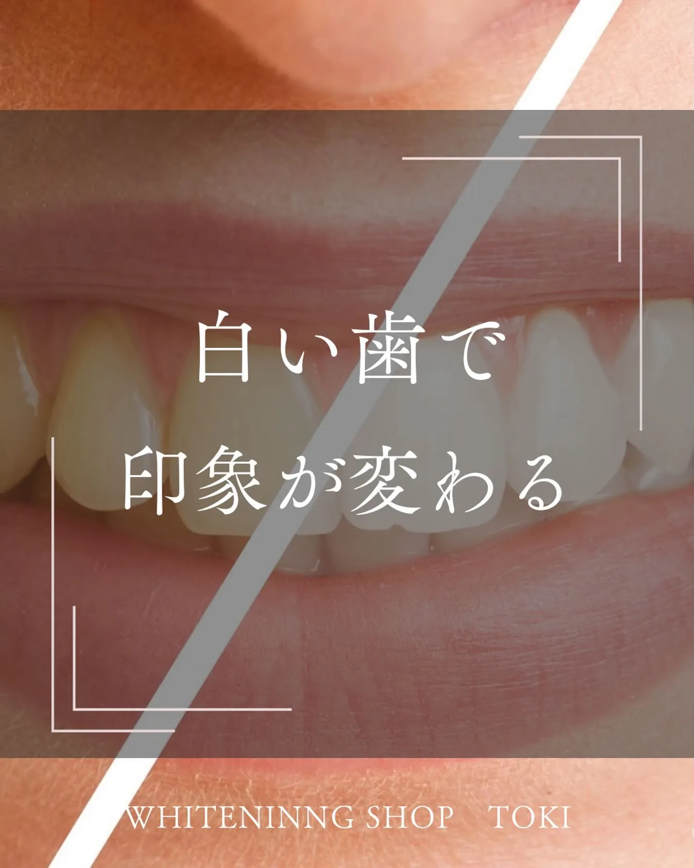 白い歯で印象が変わる🦷✨️
