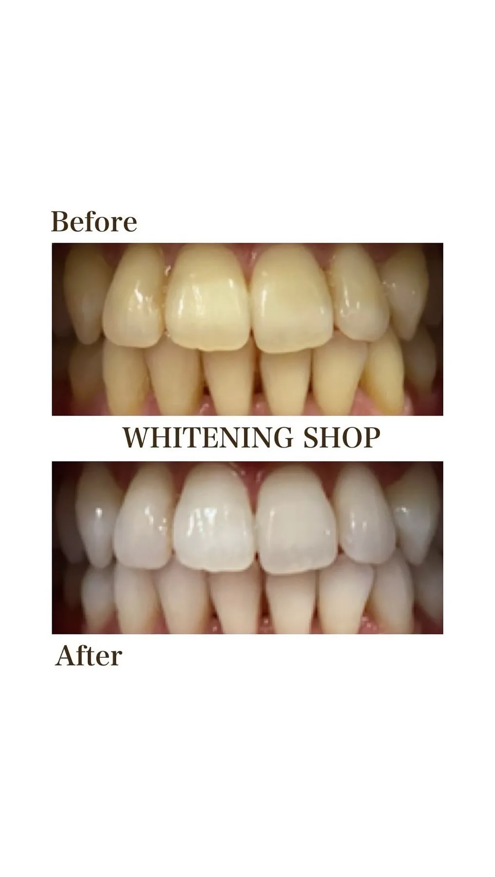 「ホワイトニングって必要？」